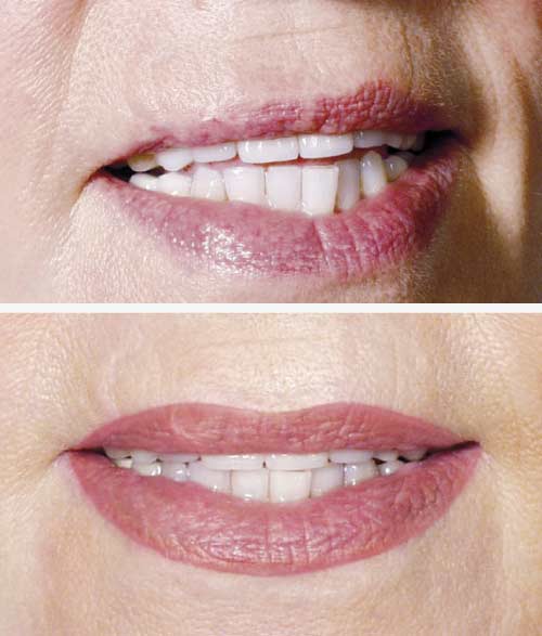 Narben-im-Lippenbereich